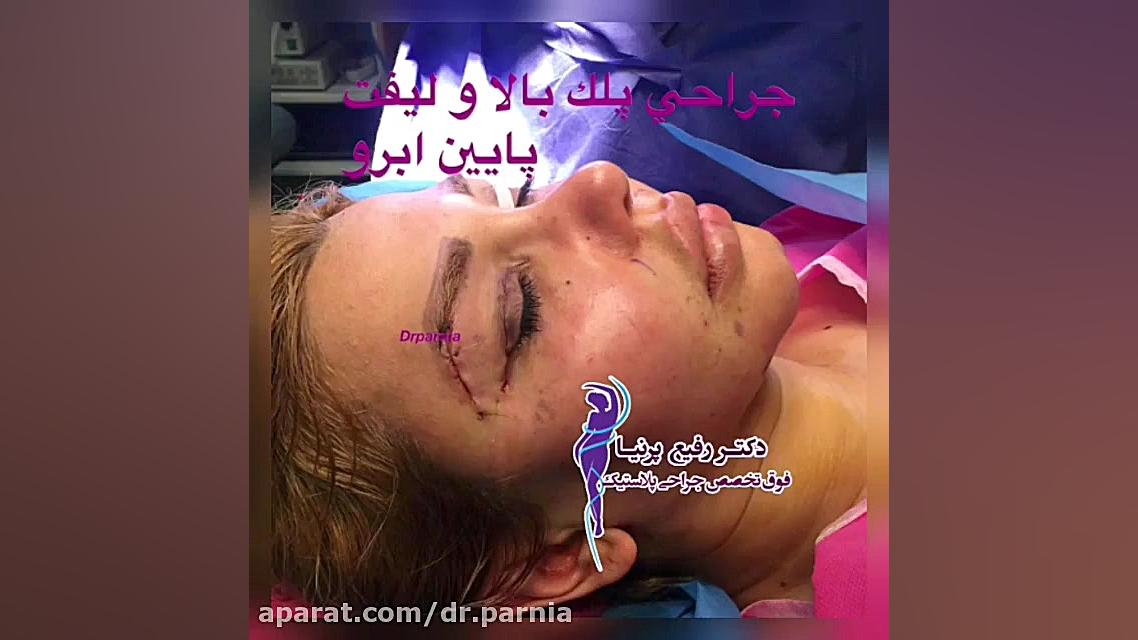 جراحی پلک بالا دکتر رفیع پرنیا فوق تخصص پلاستیک