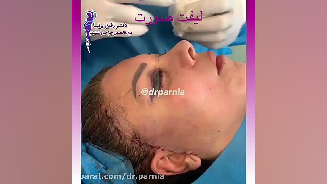 جراحی لیفت صورت دکتر رفیع پرنیا فوق تخصص پلاستیک