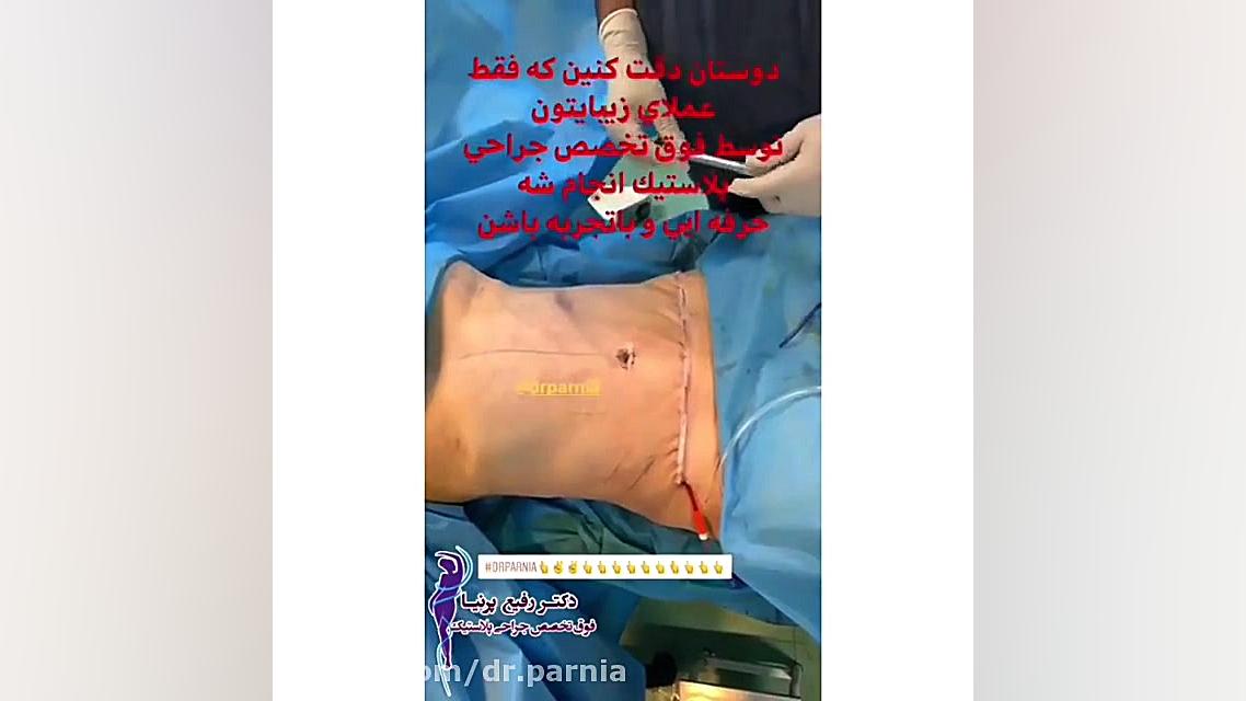 لیپوماتیک و حذف چربی با دستگاه پال دکتر رفیع پرنیا فوق تخصص پلاستیک