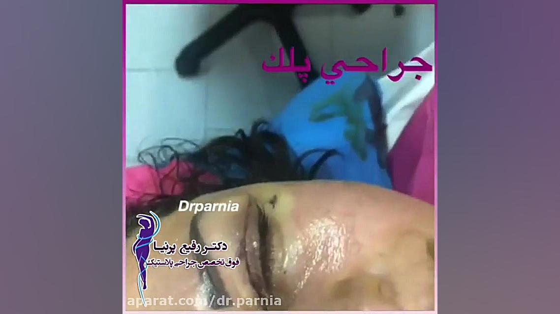 فیلم جراحی پلک دکتر رفیع پرنیا فوق تخصص پلاستیک