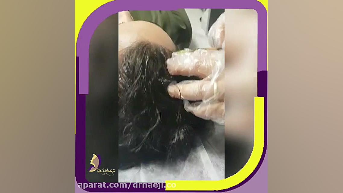 تزریق پی ار پی در ساوه دکتر صدیقه نائیجی | متخصص پوست و مو در قم