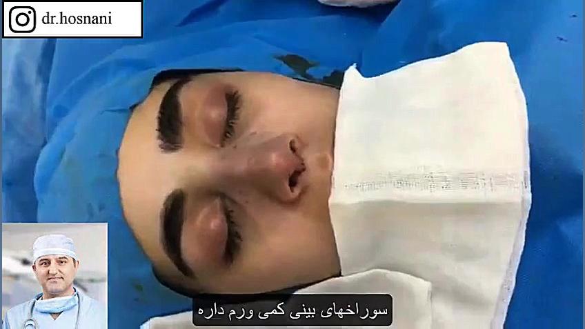 جراحی بینی طبیعی برای رومینا خانوم: نتیجه عمل عالی شد! نقص اسیدهای چرب زنجیره متوسط