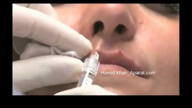 تزریق ژل لب تست مهار دگزامتازون