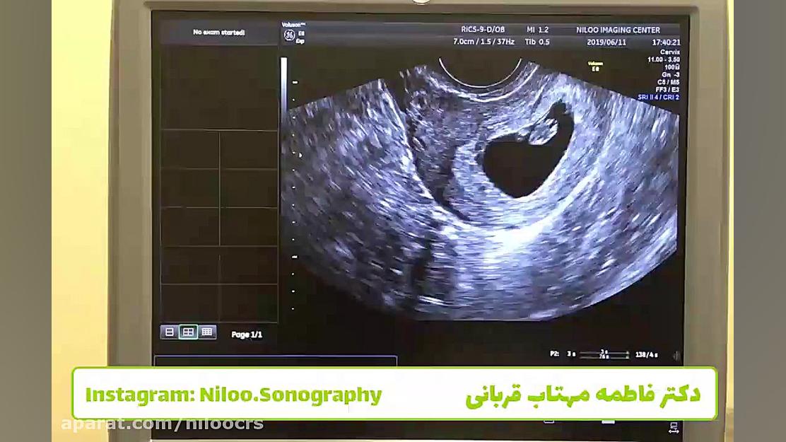 اولین ضربان قلب جنین سونوگرافی نیلو دکتر فاطمه مهتاب قربانی