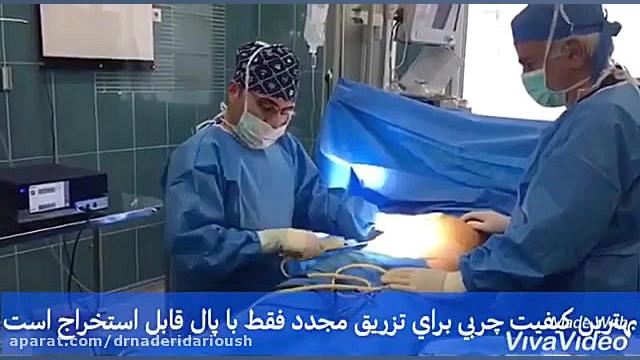 فیلم لیپوماتیک یا پیکر تراشی روکش دندان