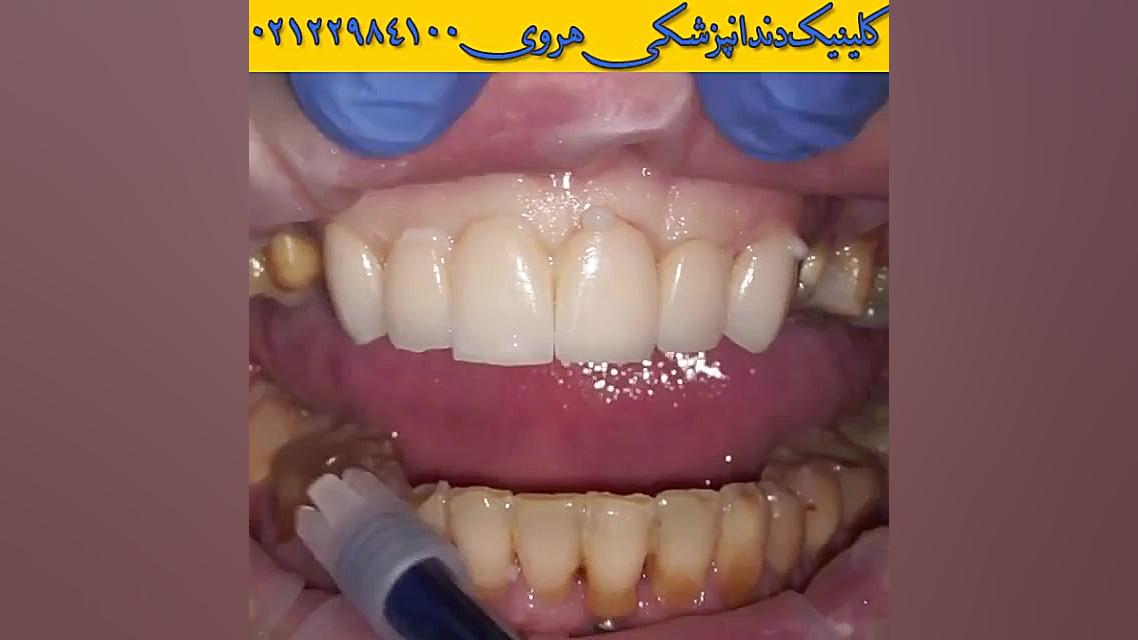 لمینت دندان | ونیر دندان | زیبایی دندان زوترلینیب