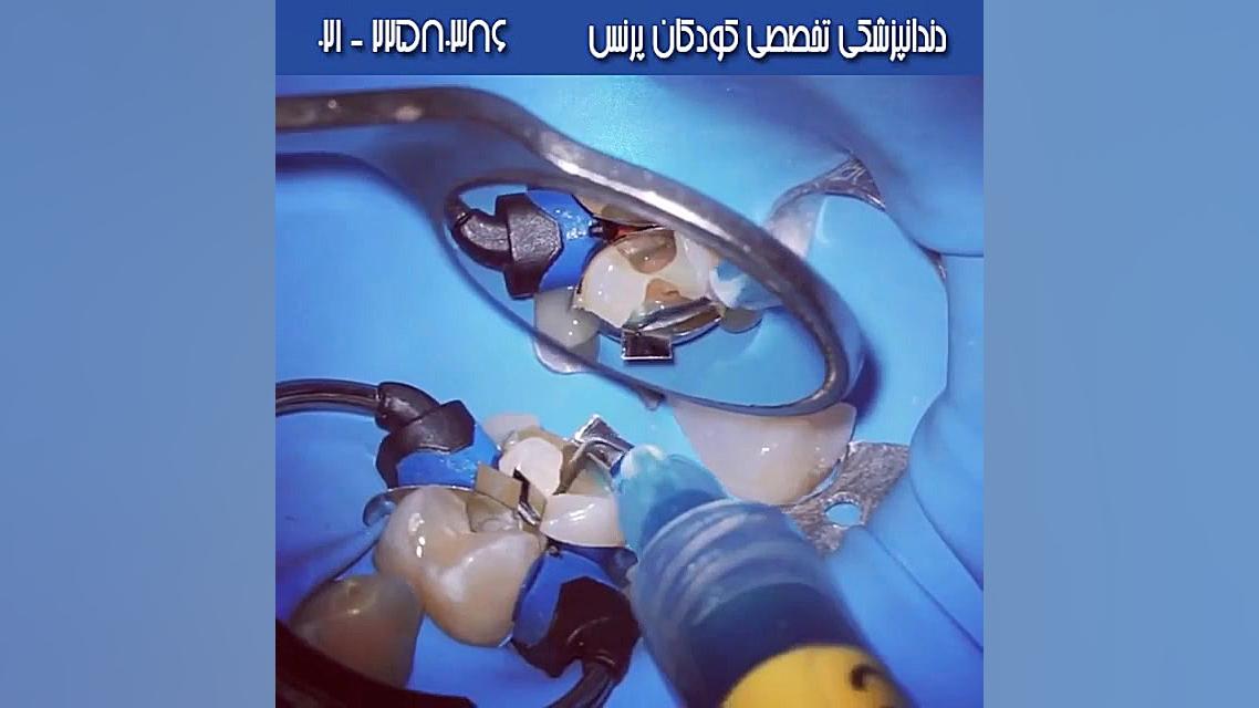 دندانپزشکی ترمیمی برای دندان های آسیاب آزمون CRISPR-Cas9 اثرات جانبی
