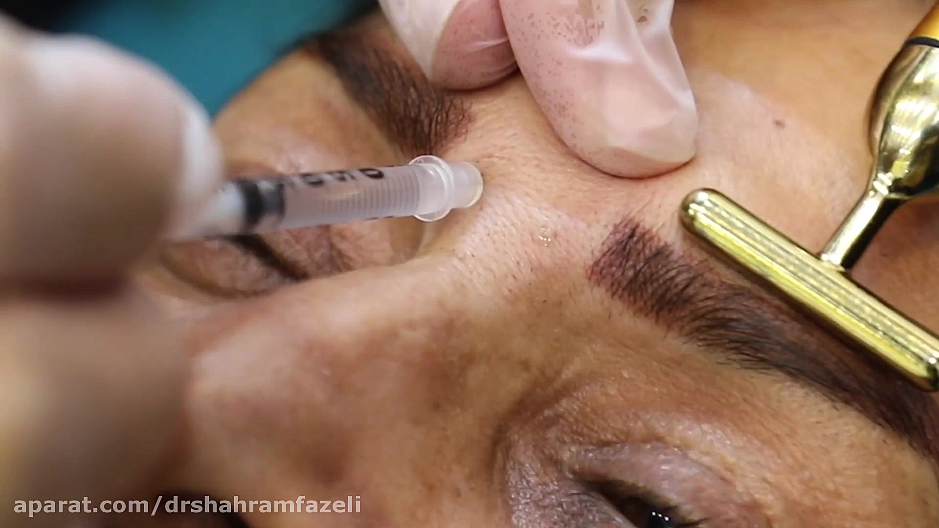 تزریق بوتاکس توسط دکتر شهرام فاضلی دکتر شهرام فاضلی - فوق تخصص جراحی پلاستیک و زیبایی