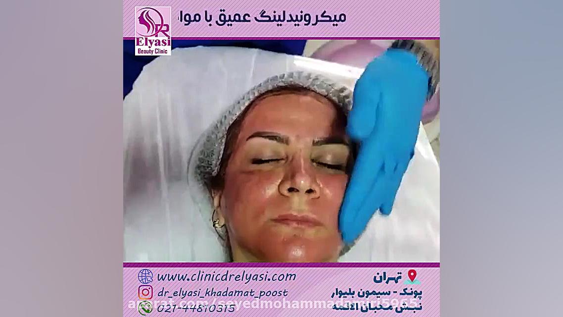 میکرونیدلینگ عمیق با مواد مزو تراپی کرانیوسینوستوز