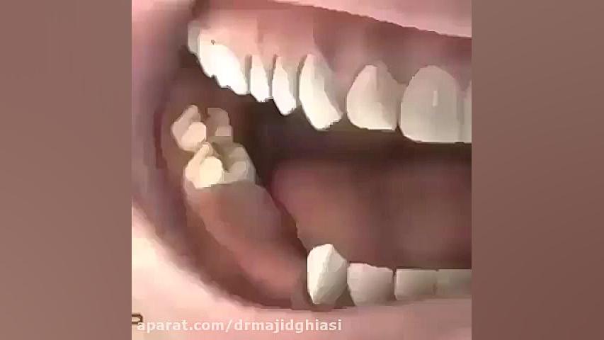 مراحل ایمپلنت دندان -دکترمجیدقیاسی دندانپزشک زیبایی مشهد پان‌سیتوپنی