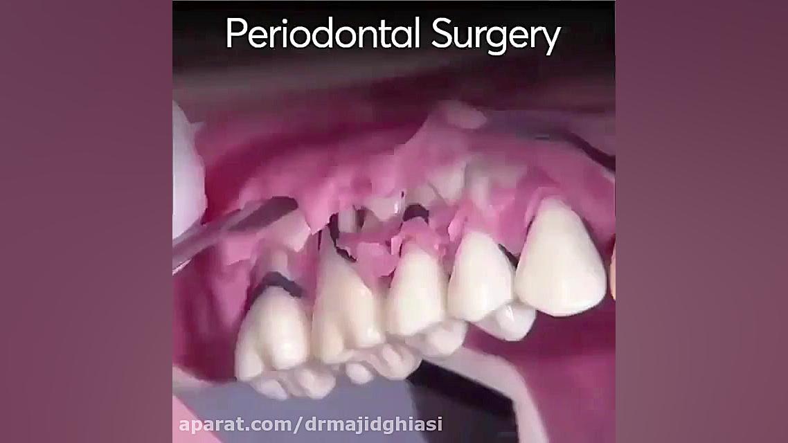 جراحی لثه-دکترمجیدقیاسی-دندانپزشک زیبایی مشهد دکترمجیدقیاسی