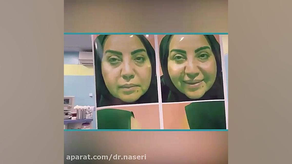 فیلم عمل لیفت صورت نوروجراحی فانکشنال