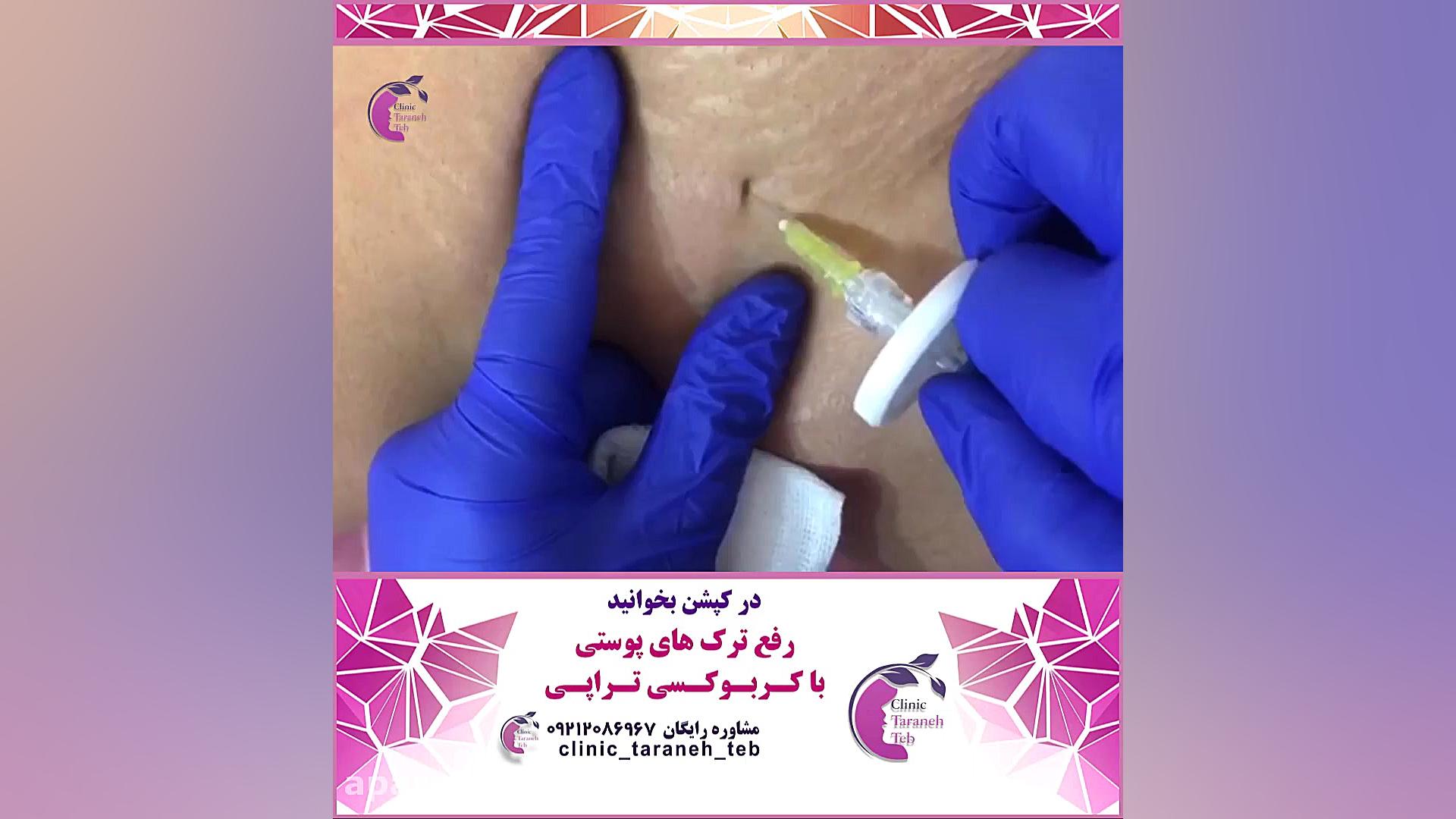 کربوکسی تراپی ترک های پوستی V/Q Scan
