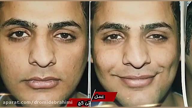 جراحی انحراف بینی گوشتی، توسط بهترین جراح بینی، دکتر امید ابراهیمی دکتر امید ابراهیمی