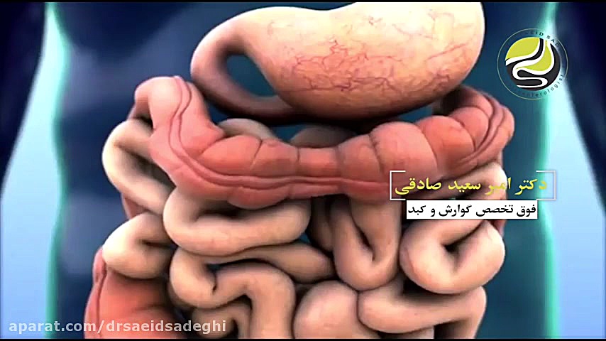 وجود بزوار در روده بیمار در حین کولونوسکوپی پاکسازی پوست