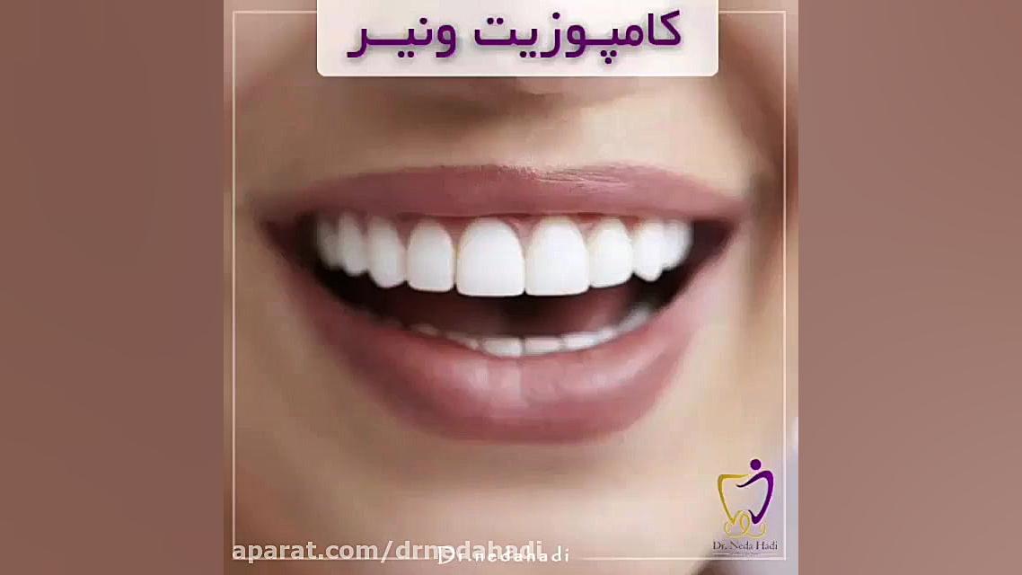 نحوه انجام کامپوزیت دندان دکتر ندا هادی-دندانپزشک زیبایی