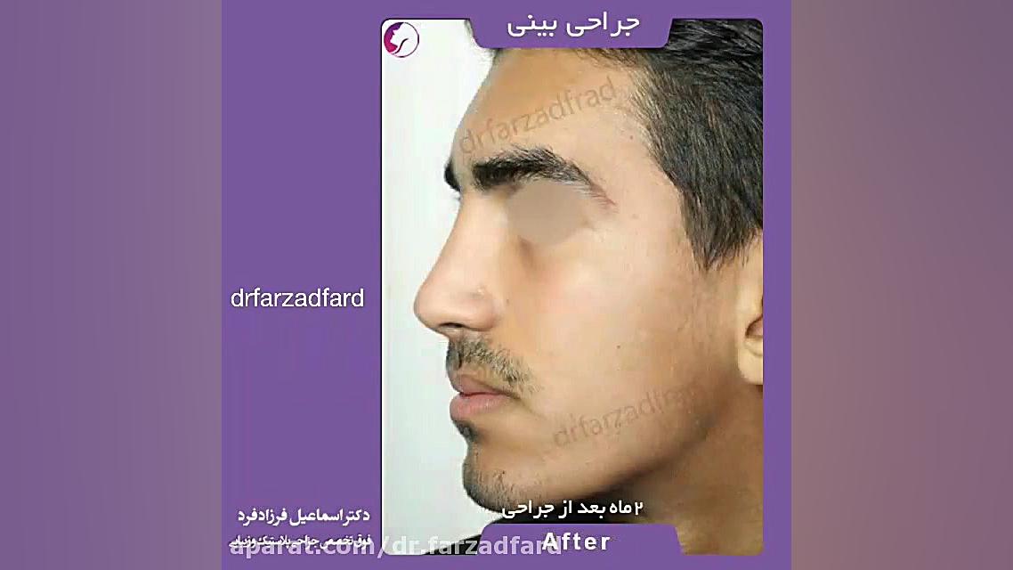 جراحی زیبایی بینی توسط دکتر فرزاد فرد دکتر اسماعیل فرزاد فرد - فوق تخصص پلاستیک