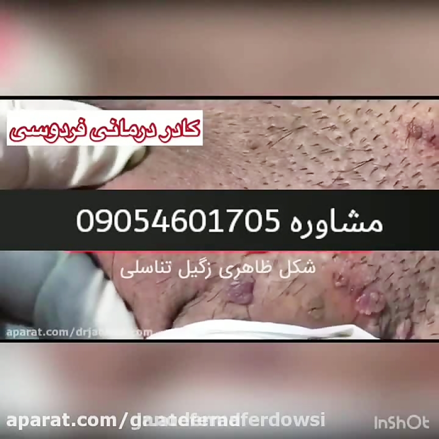 شکل و علائم زگیل تناسلی در مردان