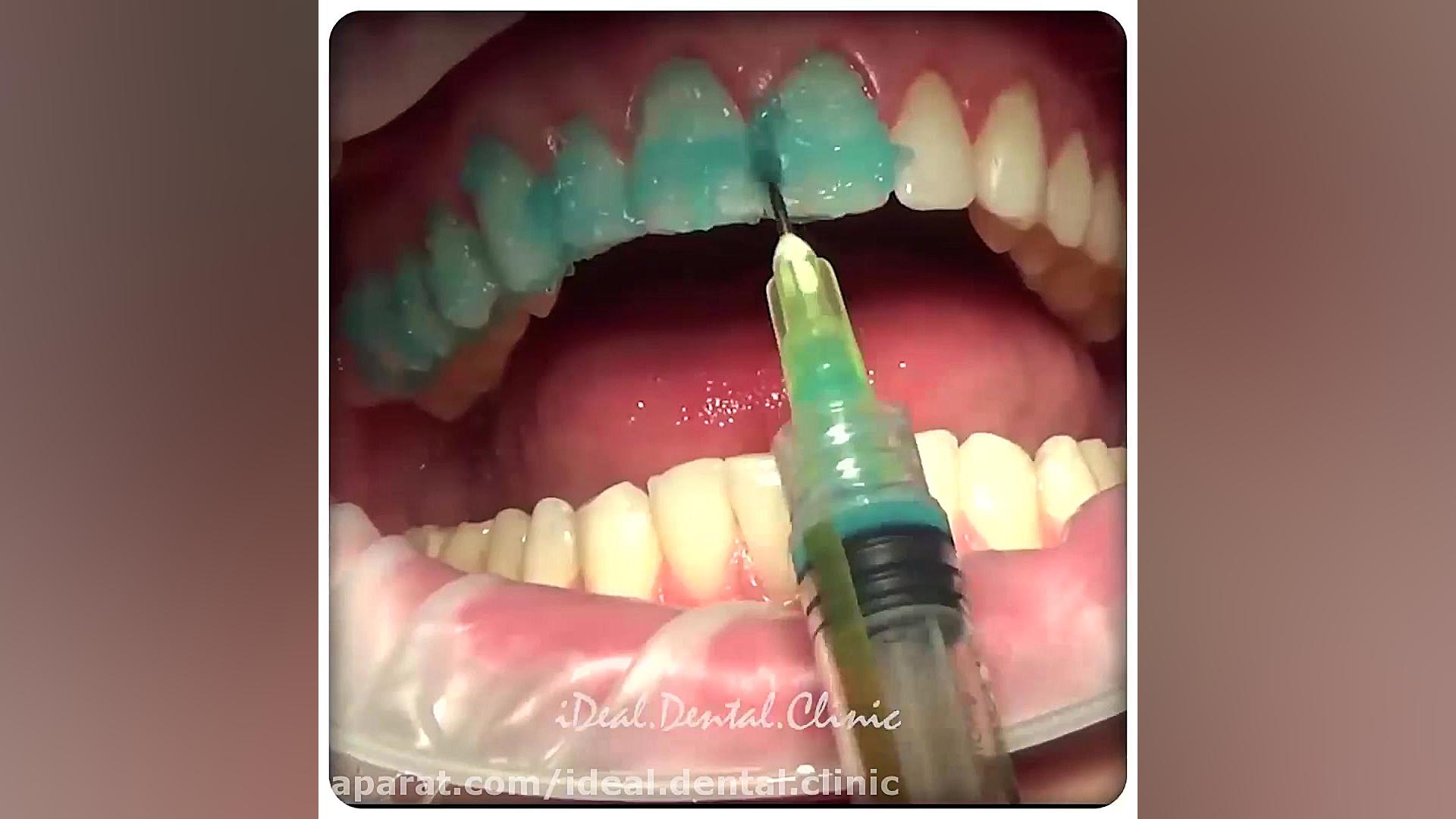 اصلاح طرح لبخند با استفاده از لمینیت سرامیکی | کلینیک دندانپزشکی ایده آل TAVI