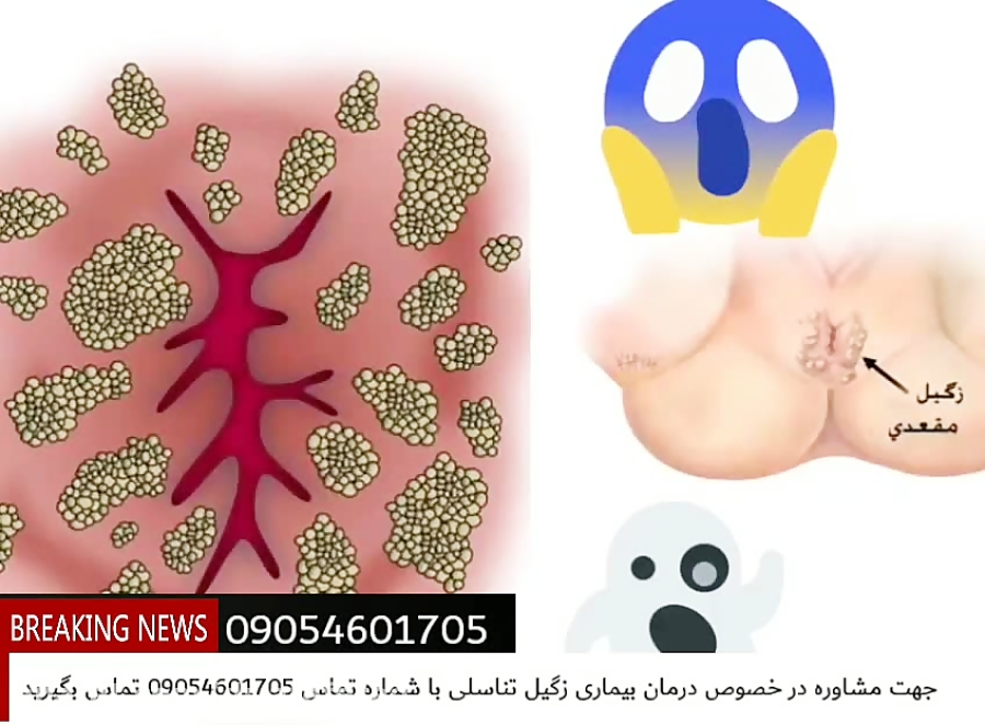 زگیل تناسلی منجر به ایدز می شود؟