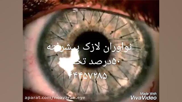 عمل پیوند قرنیه چیست ترمیم سوختگی