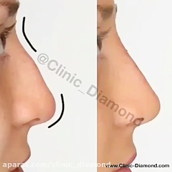 نحوه فرم دهی بینی