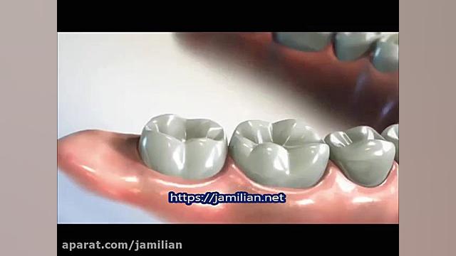 نحوه صاف کردن دندان عقل دکتر عبدالرضا جمیلیان - متخصص ارتودنسی