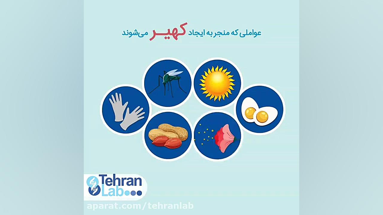 علت کهیر چیست سحر دولتشاهی