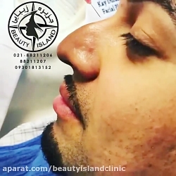 اصلاح فرم بینی بدون عمل جراحی