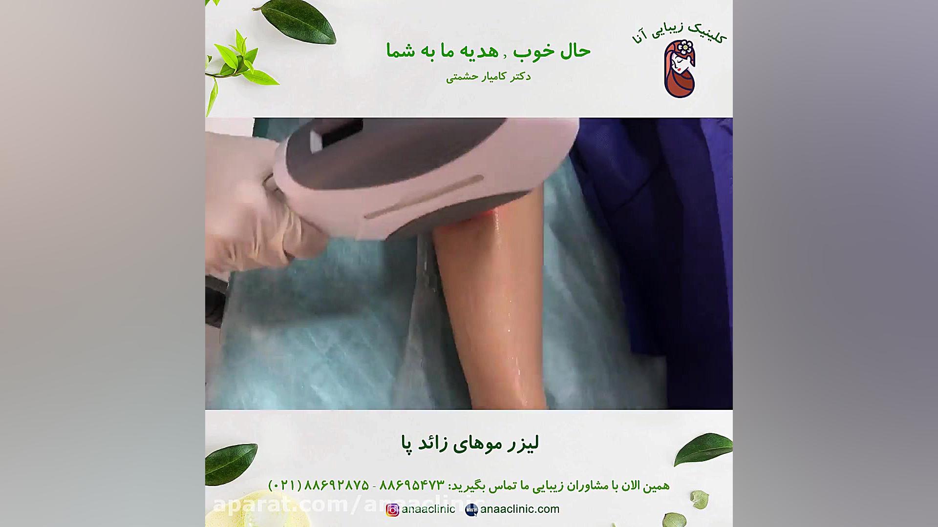 لیزر موهای زائد ساق پا - کلینیک زیبایی آنا پالبوسیکلیب