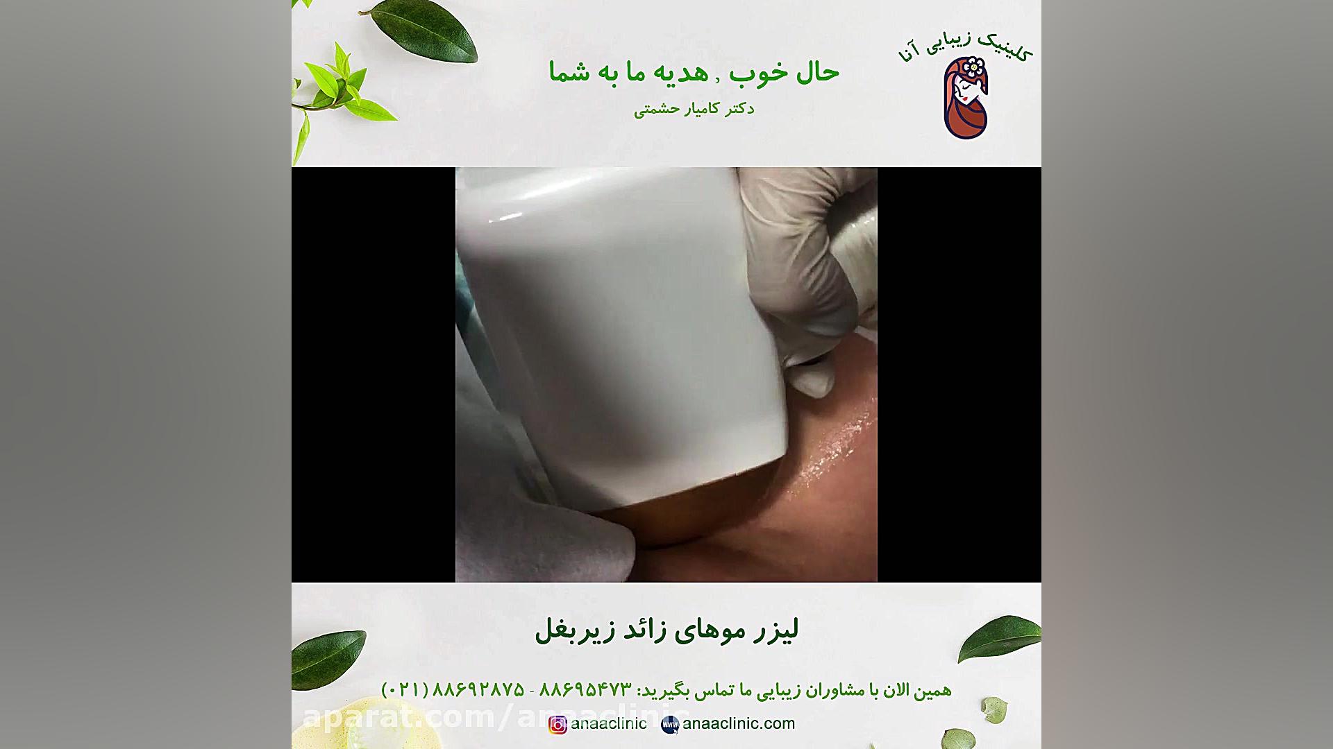 لیزر موهای زائد زیر بغل - کلینیک زیبایی آنا عمل زیبایی