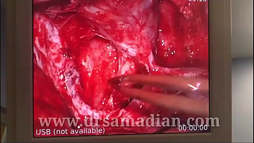 عمل جراحی میکروسکوپی آزادسازی عصب بینایی و ترمیم کره چشم لیفت پیشانی