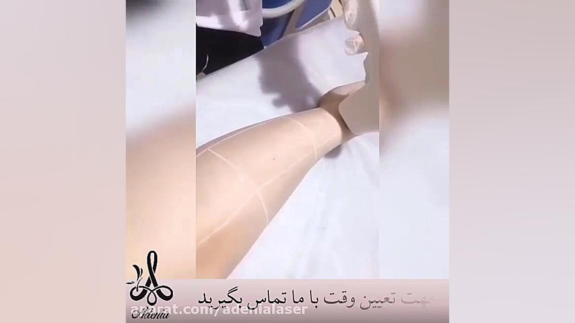 لیزر موهای زائد با الکس دایود 2019 سندرم چیلبلینز