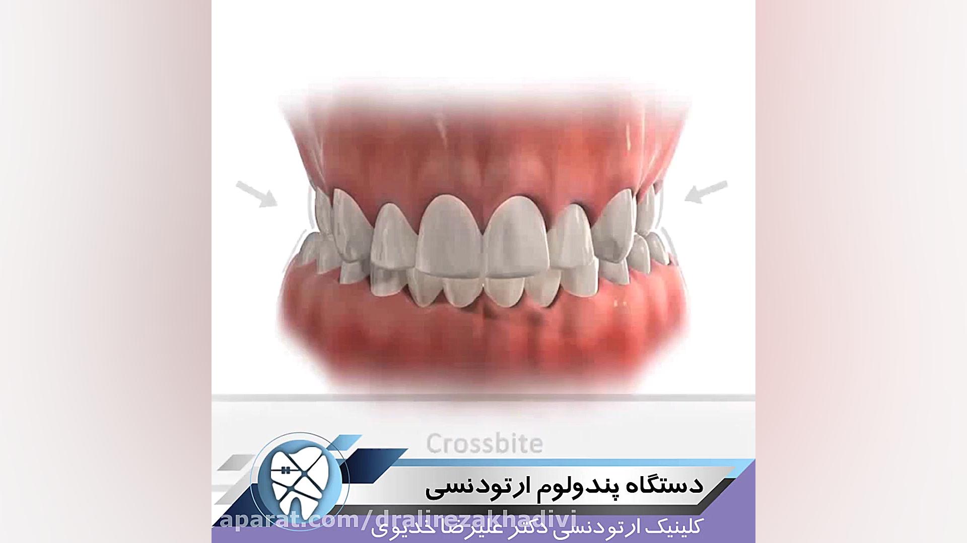 دستگاه پندولوم ارتودنسی دکتر علیرضا خدیوی