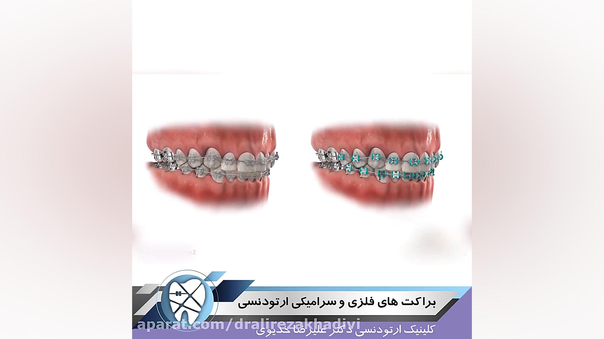 براکت های فلزی و سرامیکی ارتودنسی دکتر علیرضا خدیوی