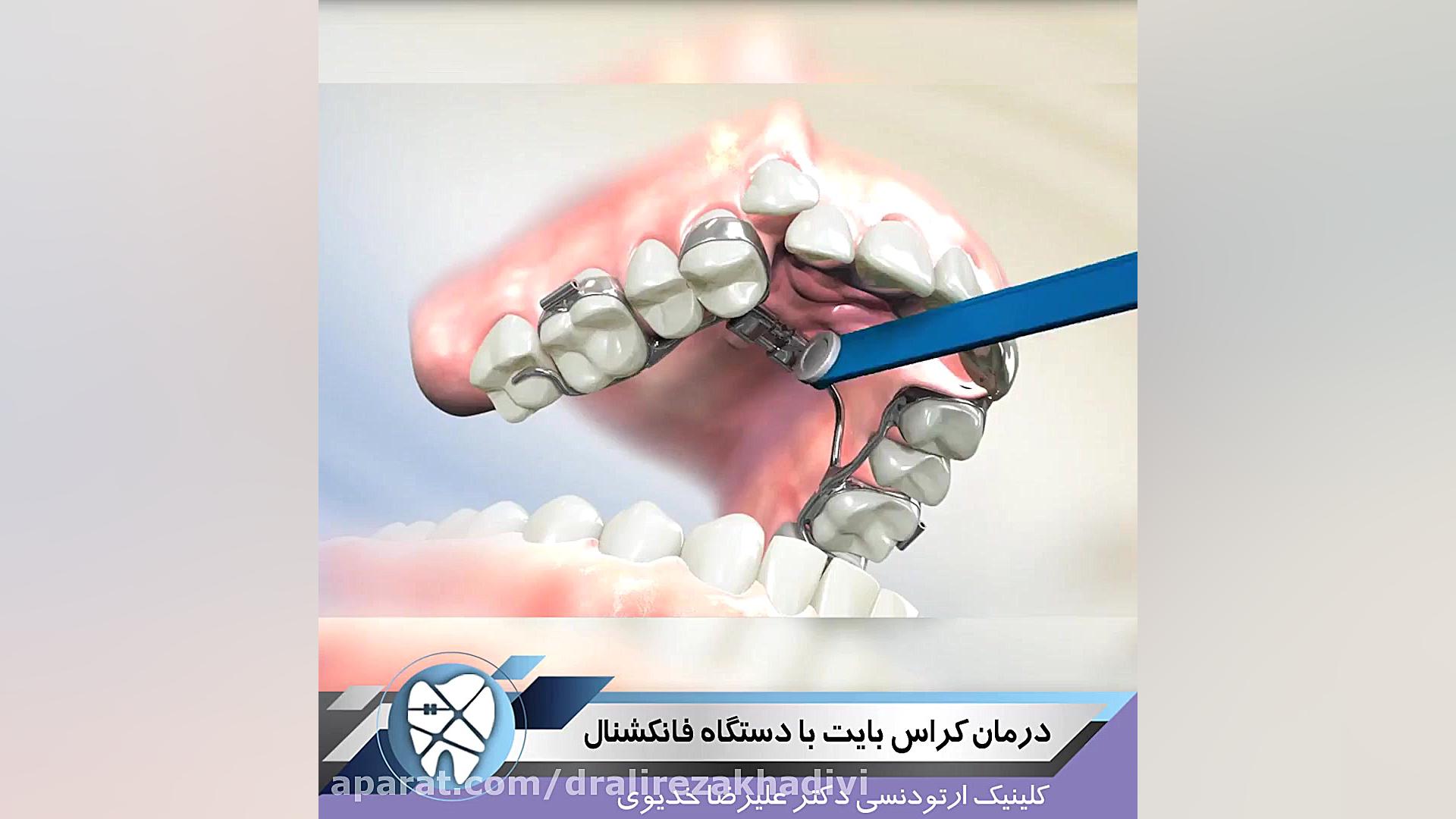 درمان کراس بایت با دستگاه فانکشنال دکتر علیرضا خدیوی