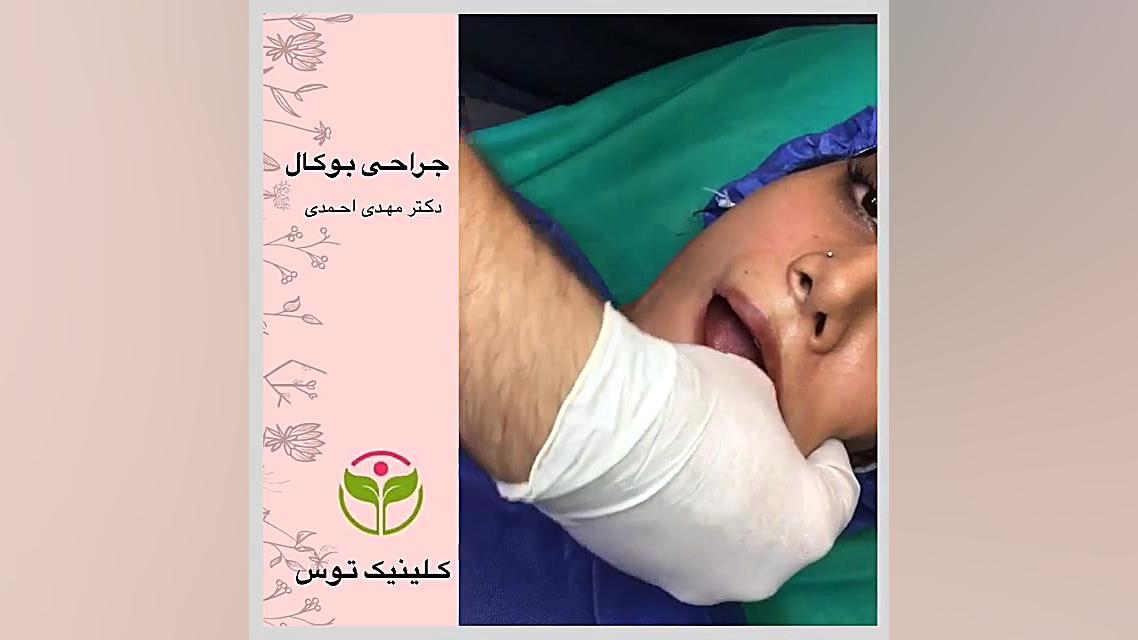 جراحی بوکال در کلینیک توس هایفوتراپی