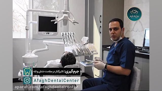 جرمگیری و برداشتن پلاک های تشکیل شده روی دندان Southern Blot