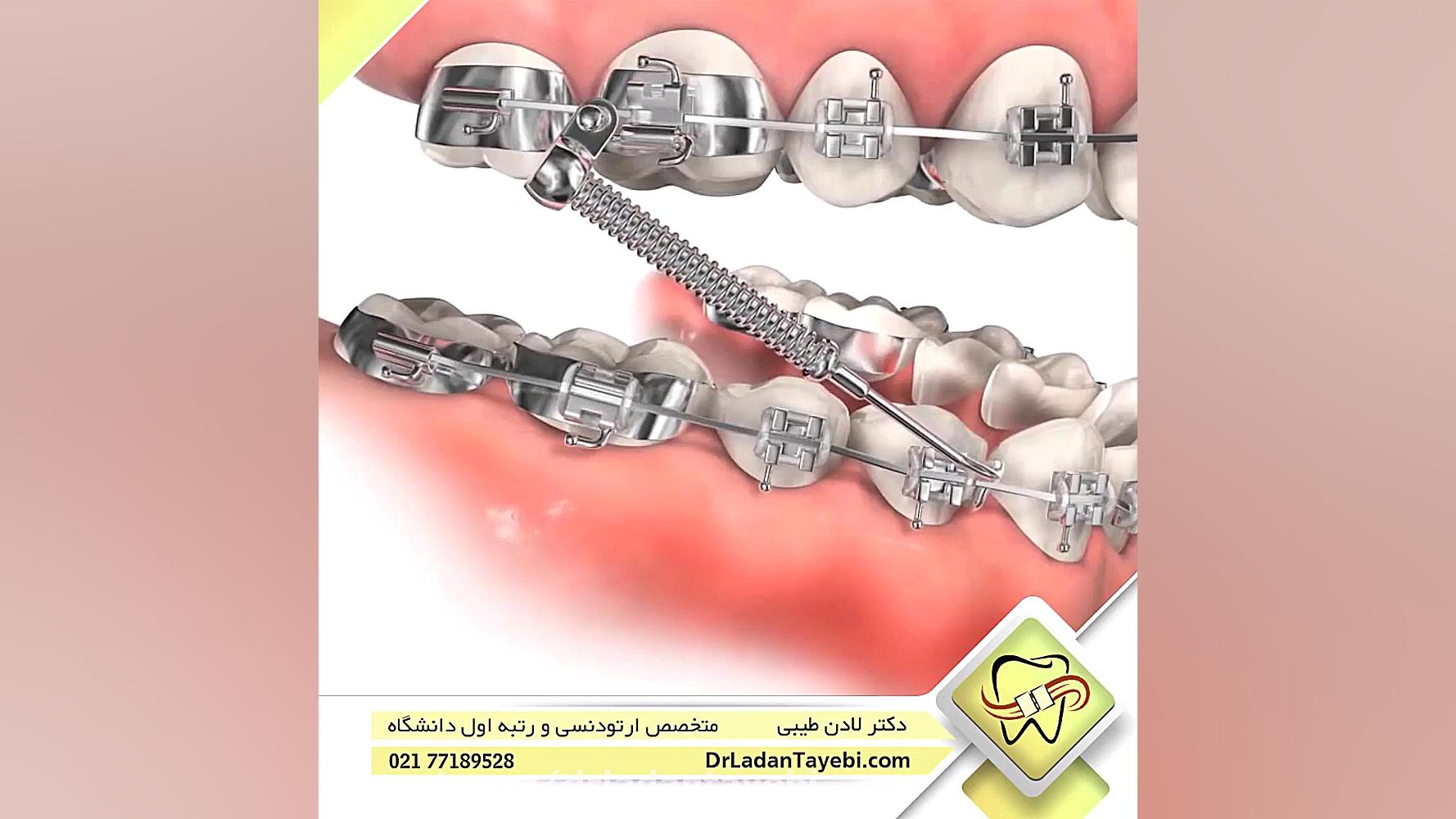 دستگاه فانکشنال ثابت | دکتر لادن طیبی عمل زیبایی