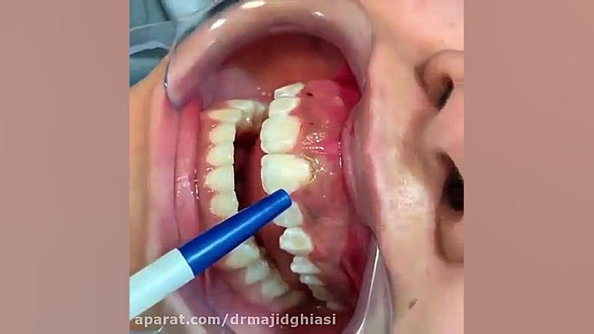 اصلاح طرح لبخند-دکترمجیدقیاسی-دندانپزشک زیبایی مشهد لیفت ابرو
