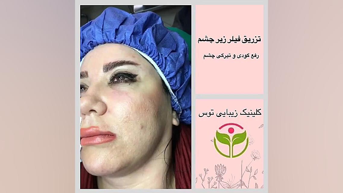 تزریق فیلر زیر چشم در کلینیک توس آر اف فرکشنال