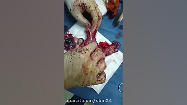 آناتومی رحم ... دکتر مریم الماسی متخصص زنان و زایمان و لاپاروسکپی برداشتن توده