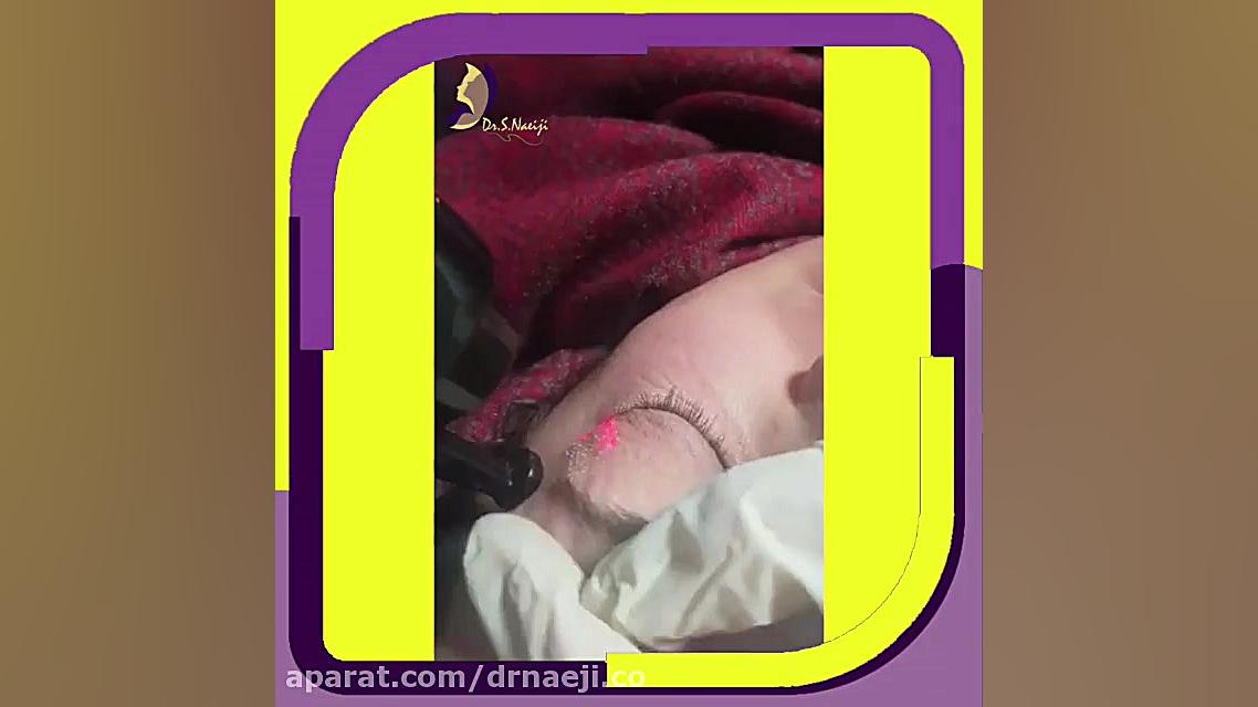 لیزر فرکشنال co2 دکتر صدیقه نائیجی در ساوه دکتر صدیقه نائیجی | متخصص پوست و مو در قم