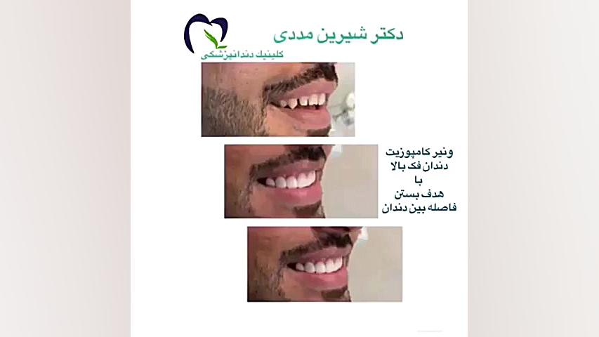 کامپوزیت ونیر دندان توسط دکتر شیرین مددی ژنراتور پالس عصبی