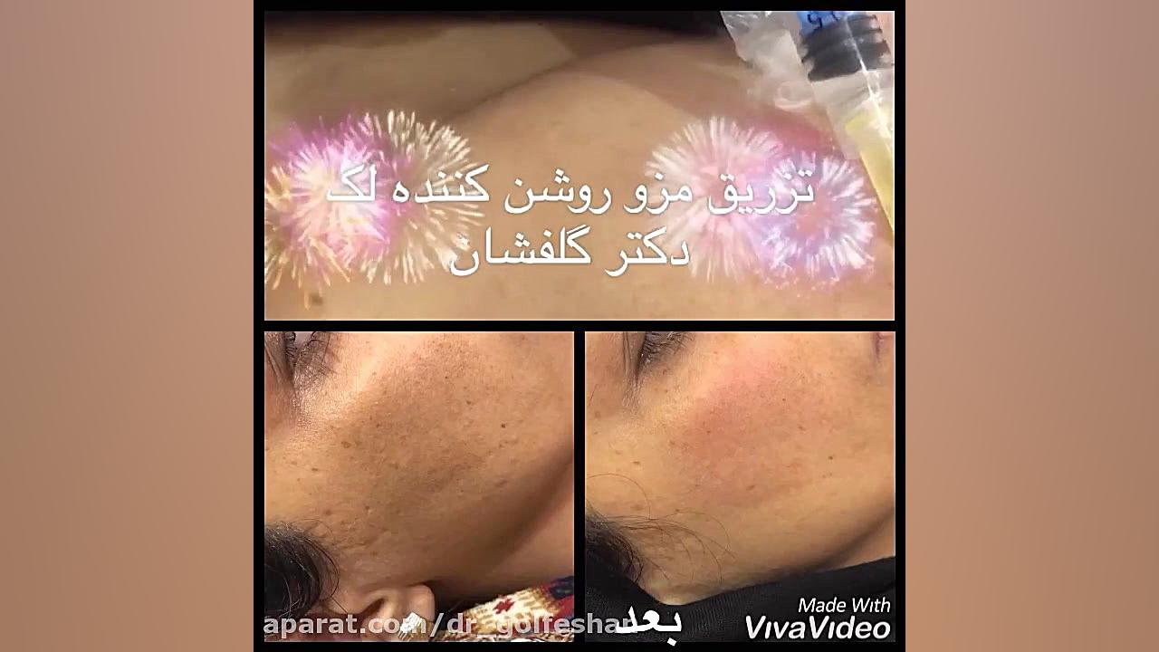 درمان ملاسما دکتر عاطفه گلفشان، متخصص پوست مو و لیزر درمانی