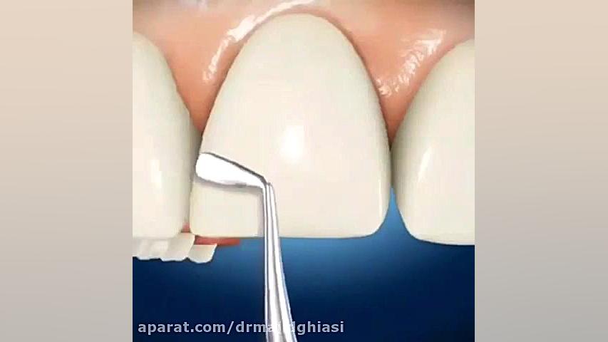 ترمیم شکستگی دندان-دکترمجیدقیاسی دندانپزشک زیبایی مشهد ماستوسیتوز
