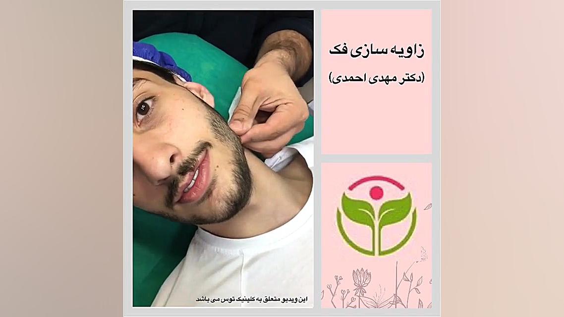 زاویه سازی فک در کلینیک توس لیزر مو