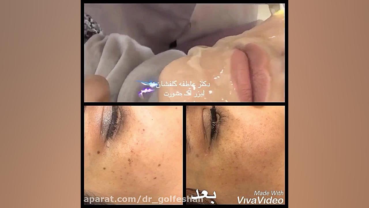درمان لک صورت با لیزر دکتر عاطفه گلفشان، متخصص پوست مو و لیزر درمانی