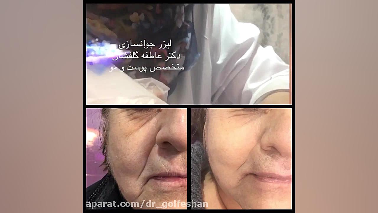 لیزر جوانسازی صورت دکتر عاطفه گلفشان، متخصص پوست مو و لیزر درمانی