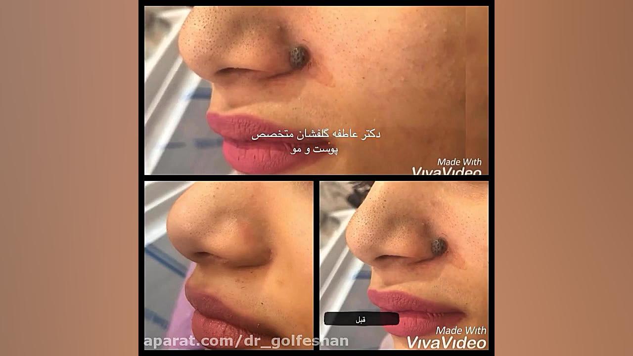 لیزر خال صورت توسط دکتر گلفشان متخصص پوست و مو دکتر عاطفه گلفشان، متخصص پوست مو و لیزر درمانی